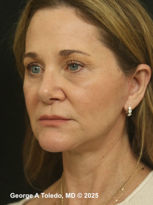 Facelift Rhinoplasty Results After