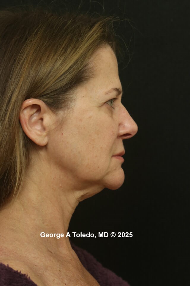 Facelift Rhinoplasty Results Before