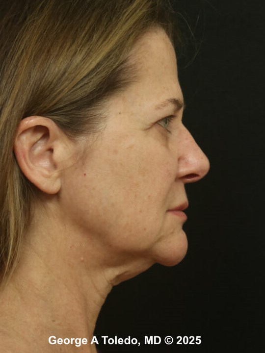 Facelift Rhinoplasty Results Before