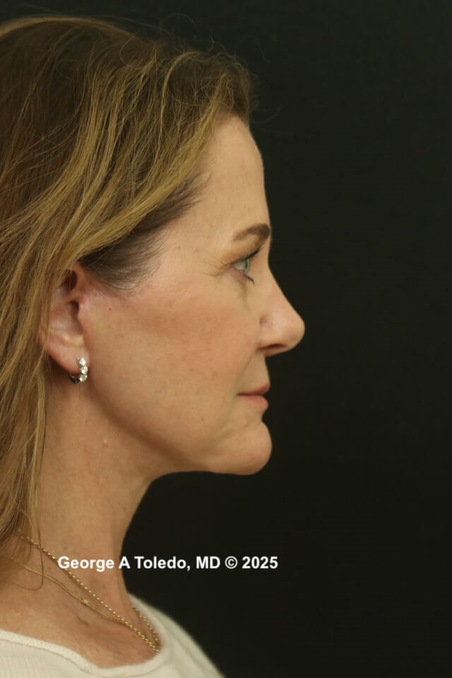 Facelift Rhinoplasty Results After