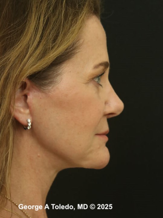 Facelift Rhinoplasty Results After