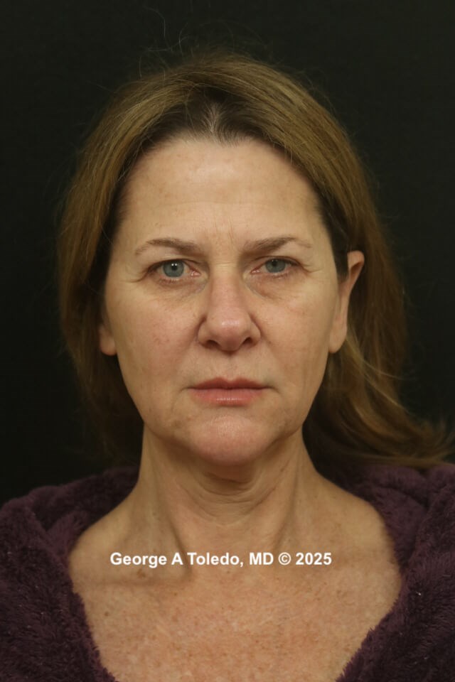 Facelift Rhinoplasty Results Before