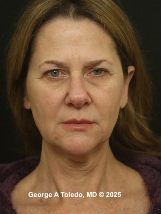 Facelift Rhinoplasty Results Before
