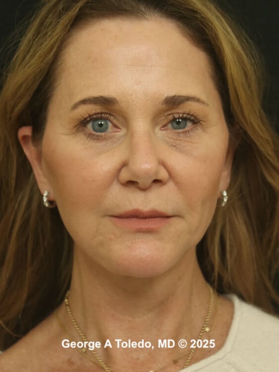 Facelift Rhinoplasty Results After