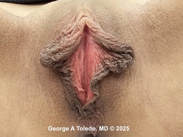 Labiaplasty Results Before