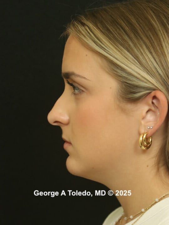 Rhinoplasty Before and After Before