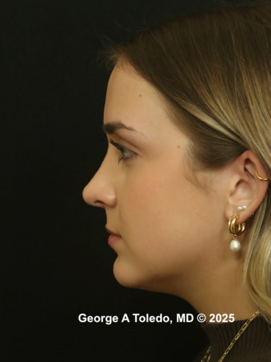 Rhinoplasty Before and After After