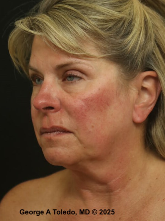 Facial Rejuvenation Results Before