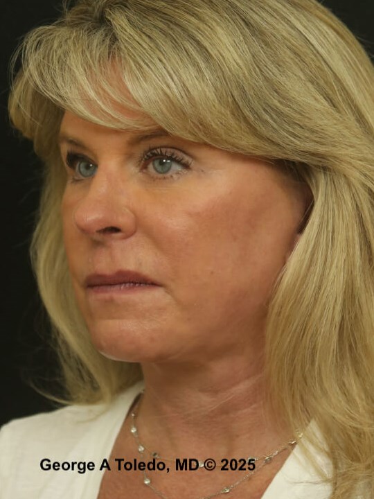 Facial Rejuvenation Results After