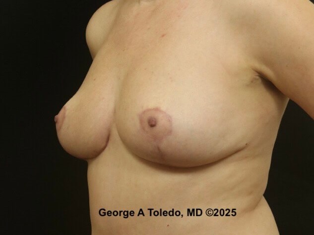 Breast Reduction/Lift Results After