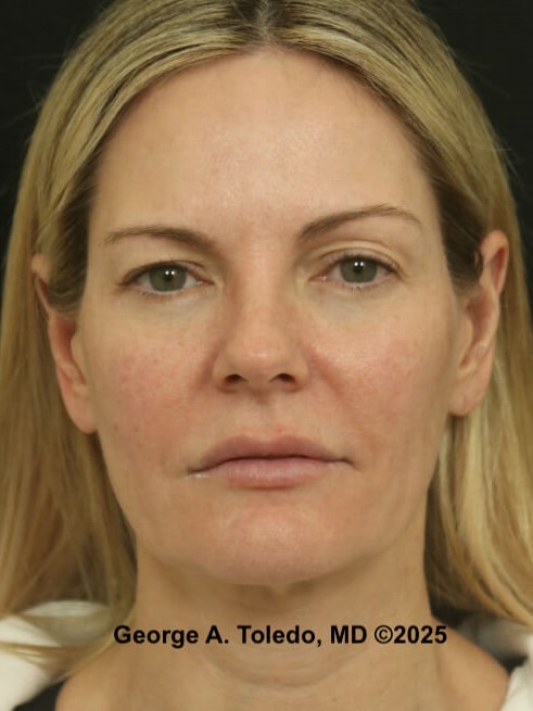 Upper Eyelid Surgery Results Before