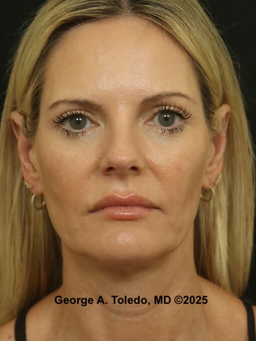 Upper Eyelid Surgery Results After