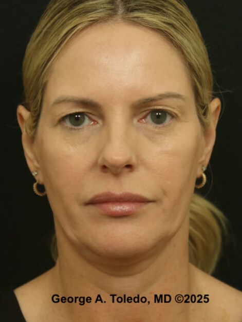Upper Eyelid Surgery Results Before