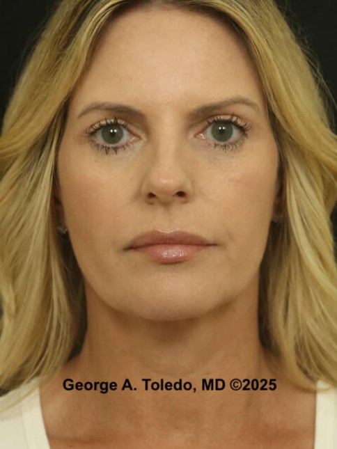 Upper Eyelid Surgery Results After