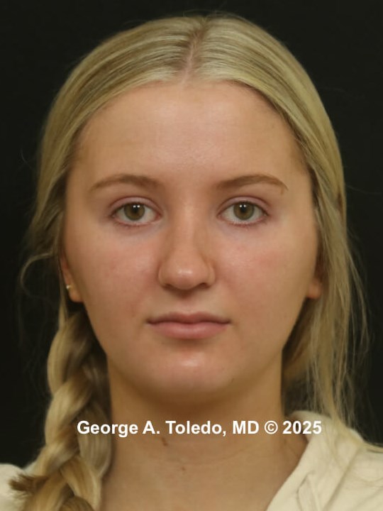 Rhinoplasty Before and After Before