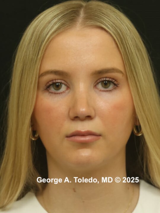 Rhinoplasty Before and After After