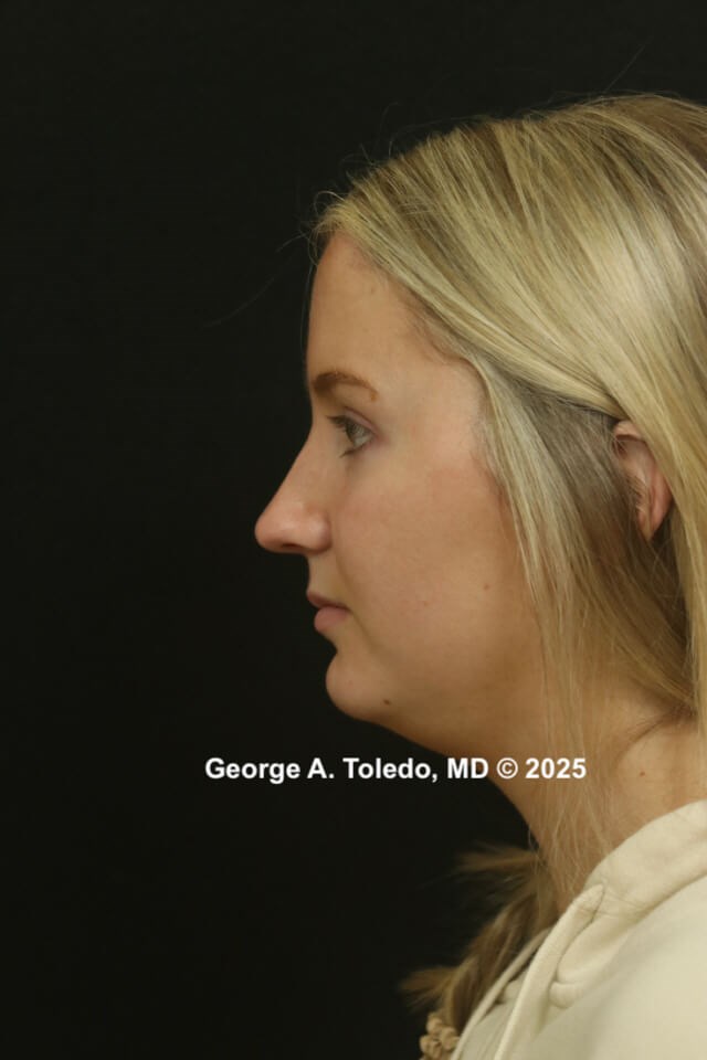 Rhinoplasty Before and After Before