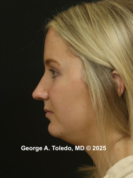 Rhinoplasty Before and After Before