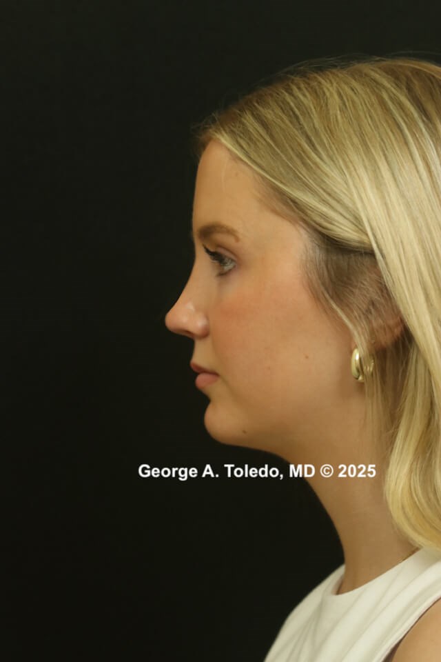 Rhinoplasty Before and After After