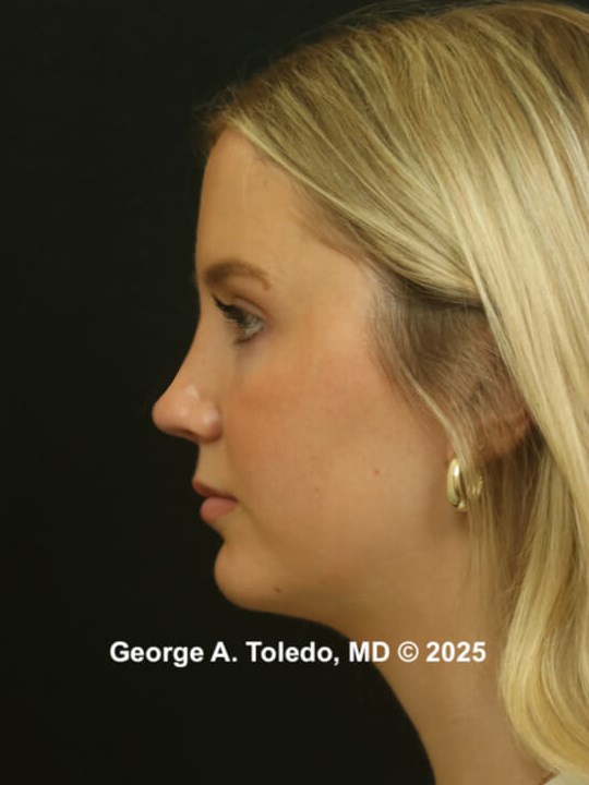 Rhinoplasty Before and After After