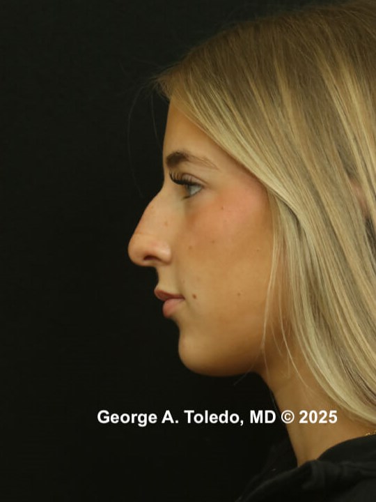 Rhinoplasty Before and After Before