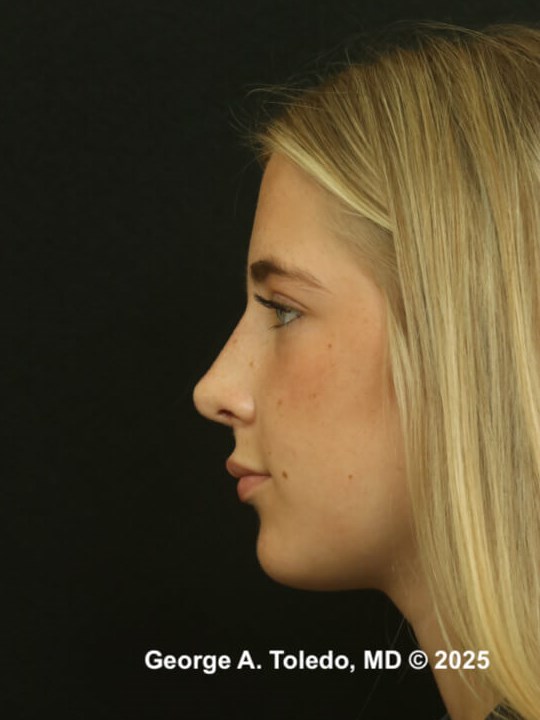 Rhinoplasty Before and After After