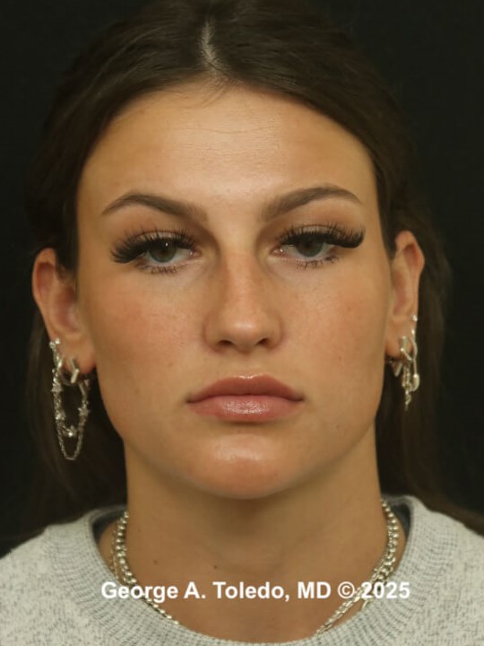 Best Rhinoplasty Results Before