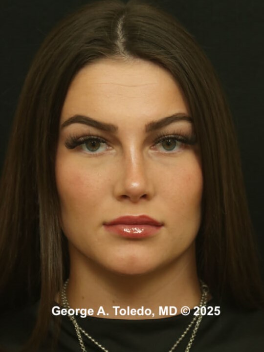 Best Rhinoplasty Results After