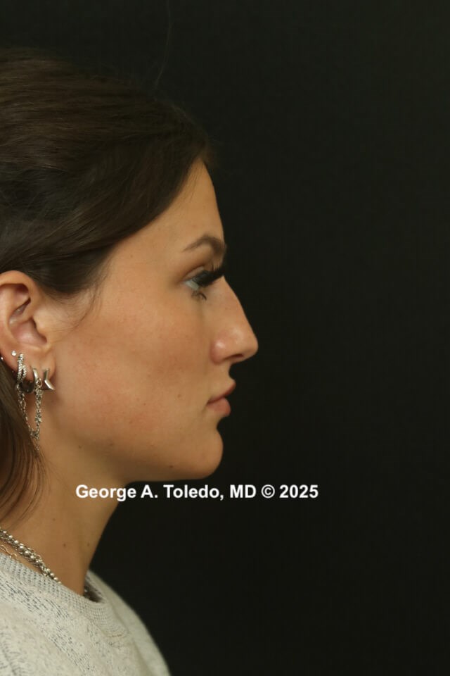 Best Rhinoplasty Results Before