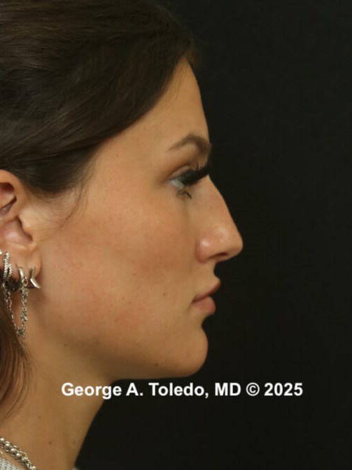 Best Rhinoplasty Results Before