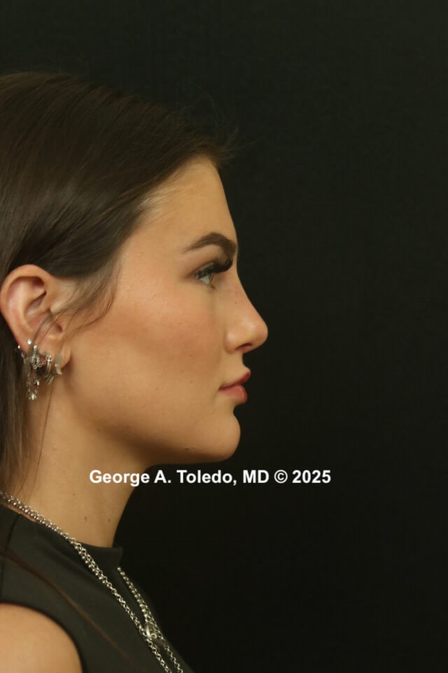 Best Rhinoplasty Results After