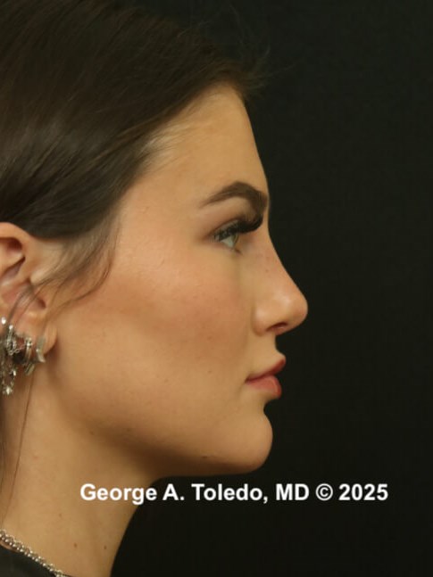 Best Rhinoplasty Results After