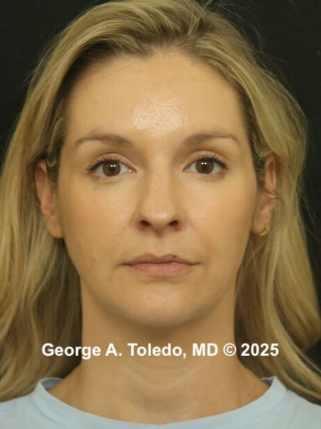 Rhinoplasty Before and After Before