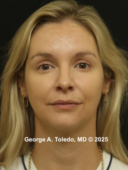 Rhinoplasty Before and After After