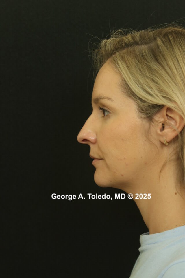 Rhinoplasty Before and After Before