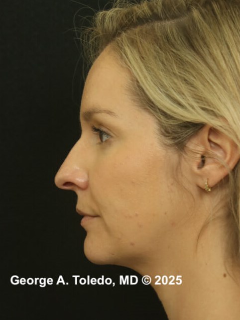 Rhinoplasty Before and After Before