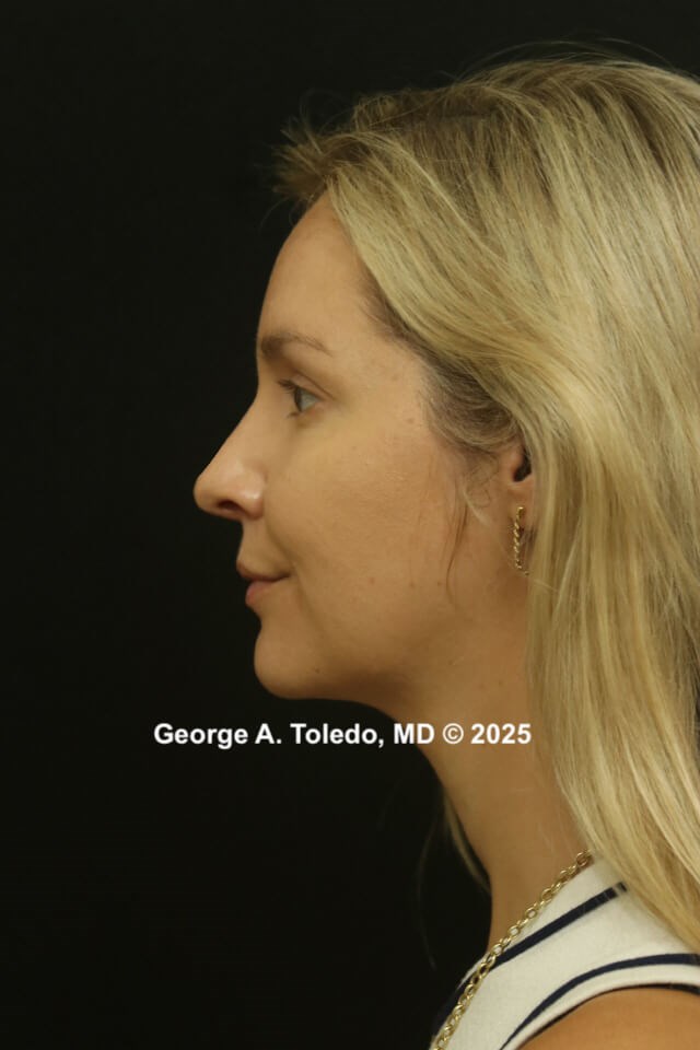 Rhinoplasty Before and After After