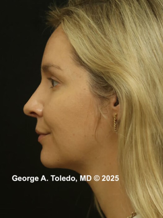 Rhinoplasty Before and After After