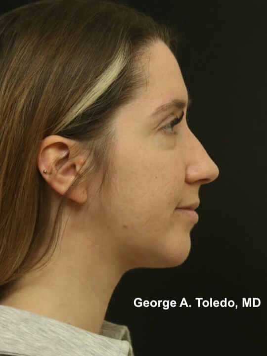 Chin Implant/Neck Liposuction After