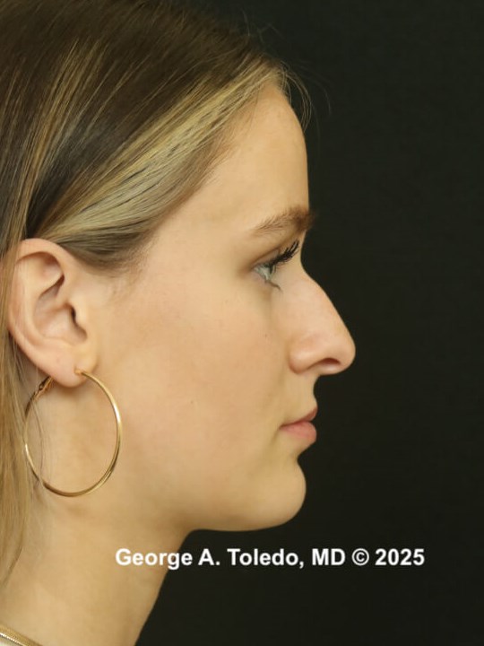 Dallas Rhinoplasty Results Before