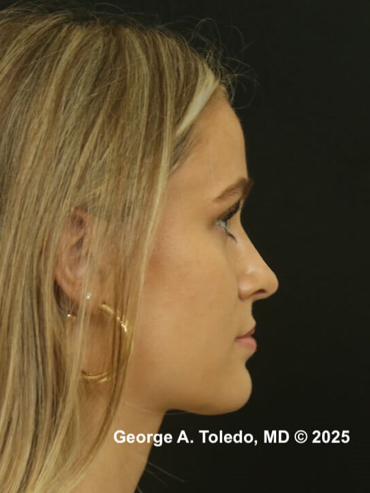 Dallas Rhinoplasty Results After