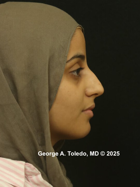 Ethnic Rhinoplasty Results Before