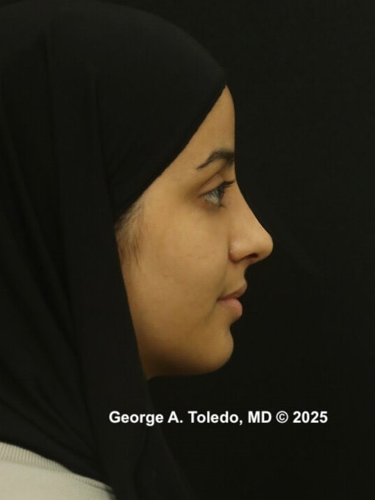Ethnic Rhinoplasty Results After