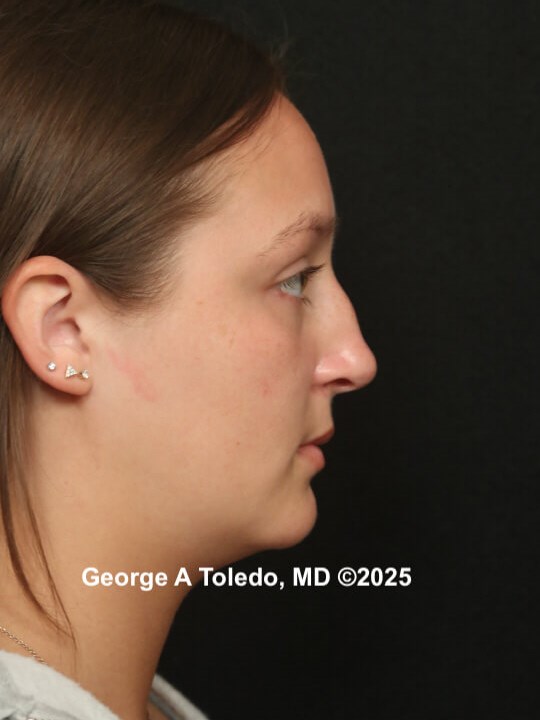 Revision Rhinoplasty Results Before