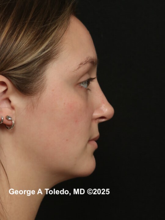 Revision Rhinoplasty Results After