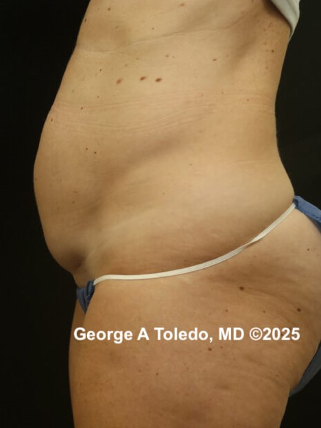 Tummy Tuck Before and Afters Before