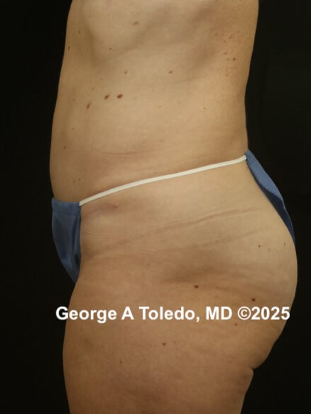 Tummy Tuck Before and Afters After