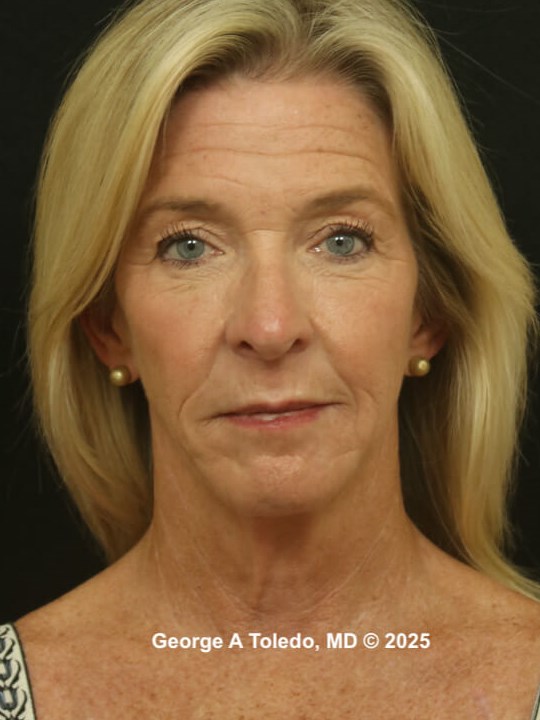 Facial Rejuvenation Results Before