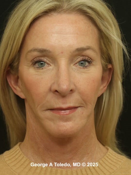 Facial Rejuvenation Results After