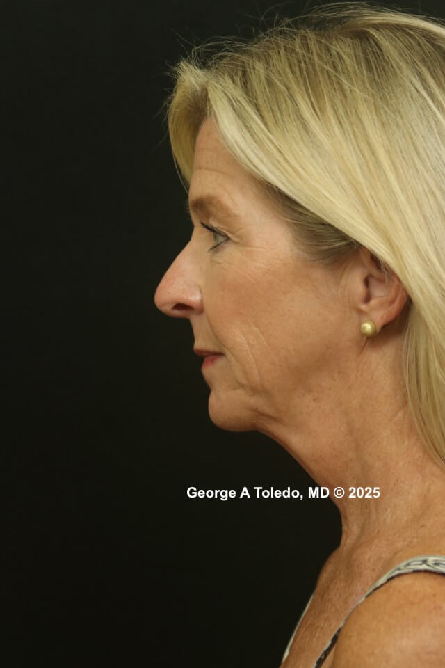 Facial Rejuvenation Results Before